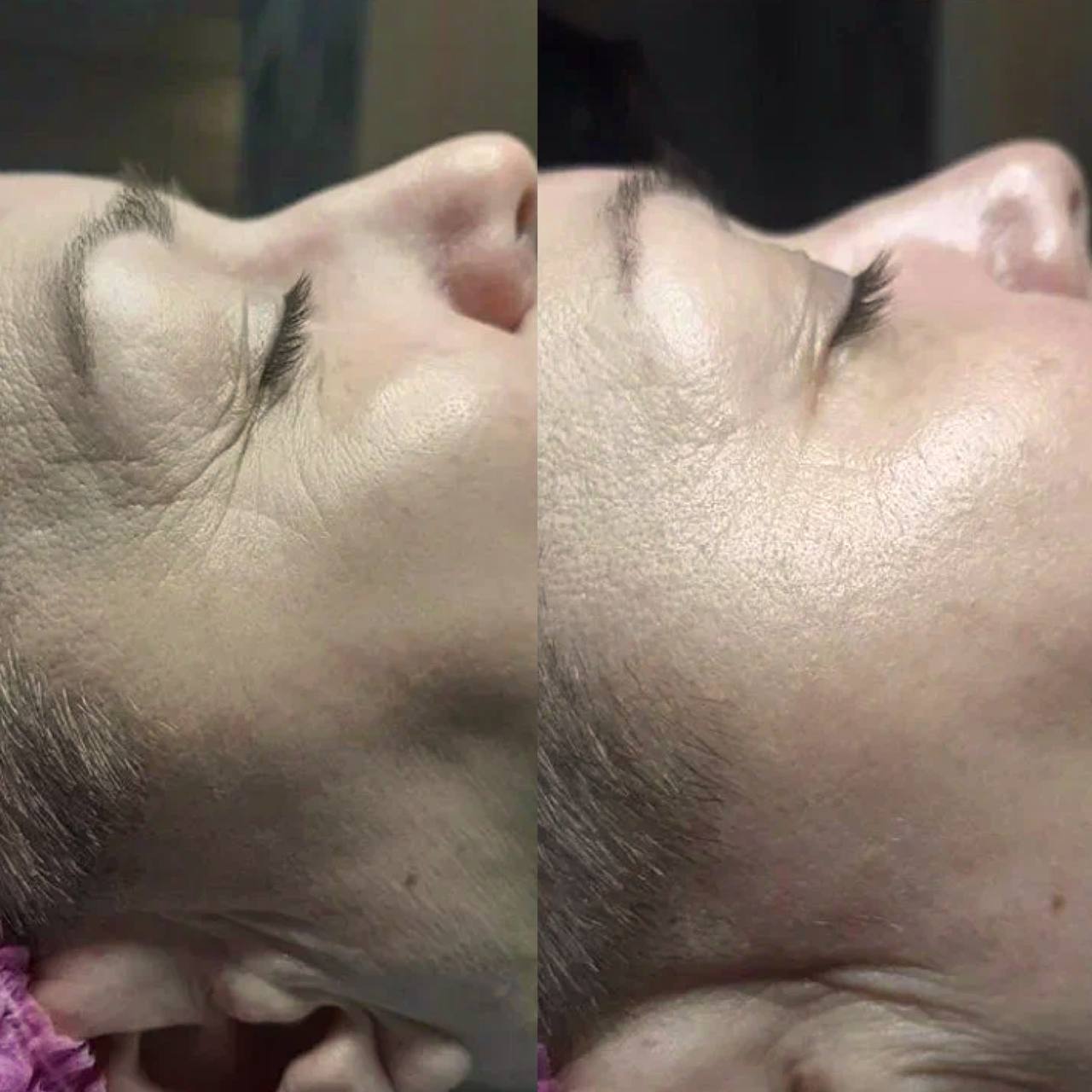 Процедура Skindex фото до и после