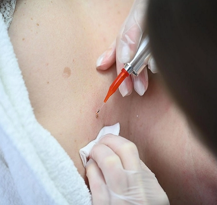 udalenie_papilom_740-700