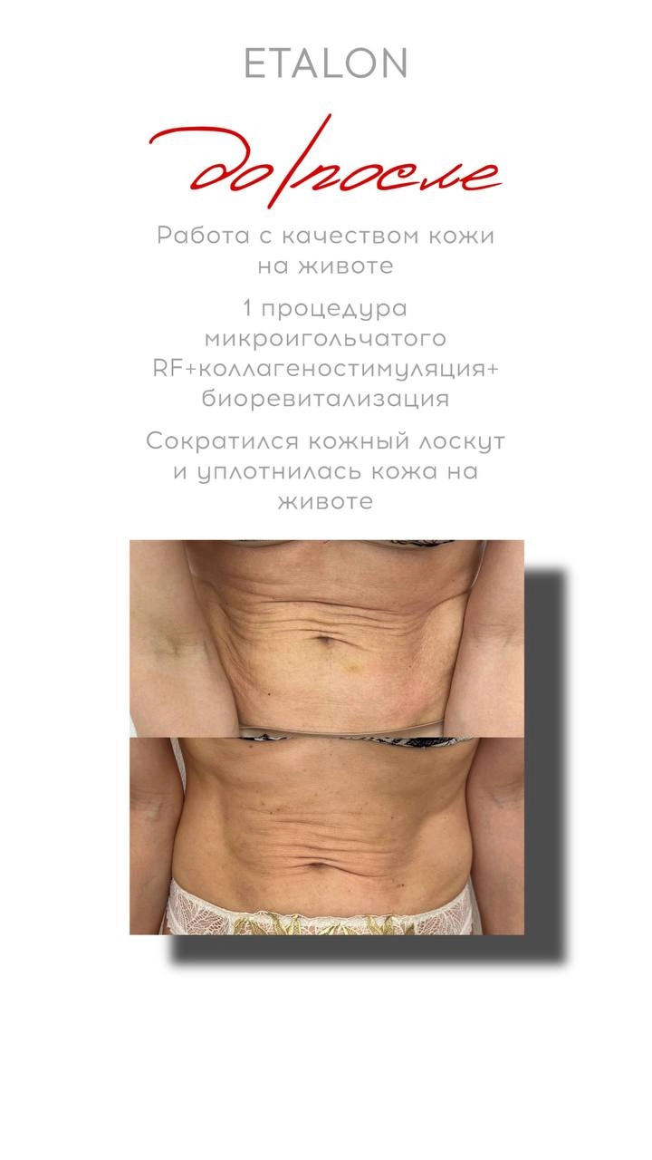 Микроигольчатый RF лифтинг до и после
