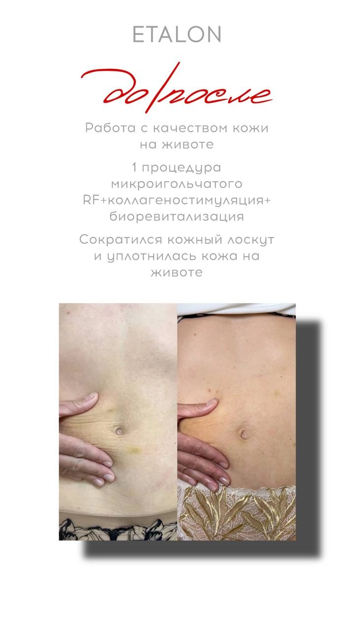 Микроигольчатый RF лифтинг до и после