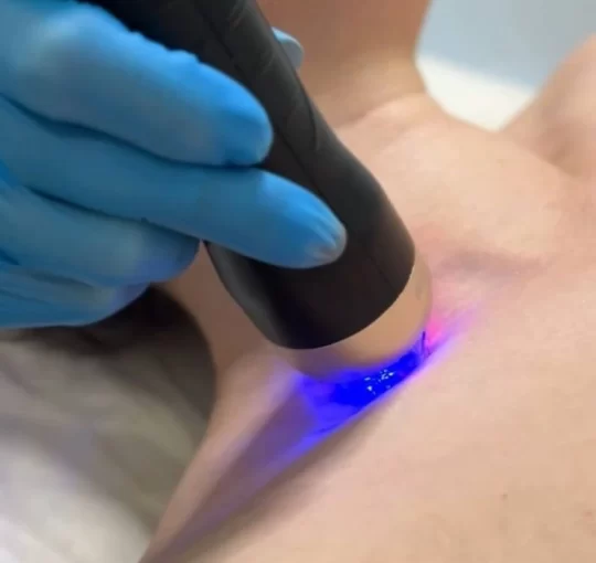 Микроигольчатый RF лифтинг 740-700